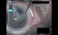 Cataract Surgery IX - Part 3