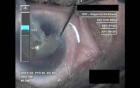 Cataract Surgery IX - Part 3