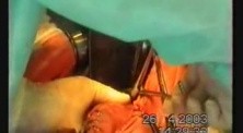 Gastric Cancer Surgery