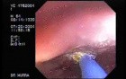 Barrett's Esophagus 