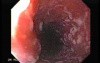 Candidiasis - Endoscopic Assessment