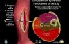 Compartment Syndrome - Video Animation
