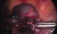 Removal of Ectopic Pregnancy by Laparoscopic Method