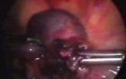 Removal of Ectopic Pregnancy by Laparoscopic Method