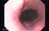 Longstanding gastroesophageal reflux disease (2 of 7)