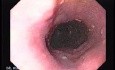 Longstanding gastroesophageal reflux disease (2 of 7)