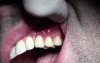 Gingival Grafting #11-12 Sites - 4 Week p-o