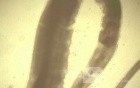 Colonoscopy observing a trichuris in the cecum (7 of 8)