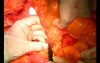 Open Right Hemicolectomy – Technical Principles - Operation No 2 - Part 3