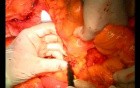 Open Right Hemicolectomy – Technical Principles - Operation No 2 - Part 3