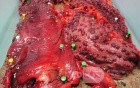 Multiple Rectal Ulcers (98 of 110)