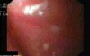 Esophageal Mycosis