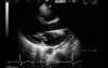 Mitral Valve - Chordal Rupture
