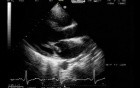 Mitral Valve - Chordal Rupture