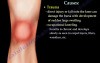 Knee Bursitis Causes - Video Lecture