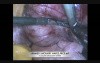 Laparoscopic Resection of Broad Ligament Myoma