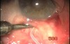 TCTCF filtration technique
