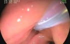 Duodenal papila adenocarcinoma- EUS staging and resection
