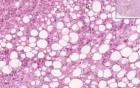 Fatty change 2 - Histopathology - Liver