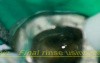Missed middle mesial canal - video