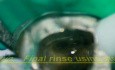 Missed middle mesial canal - video