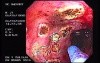 Radiation Proctosigmoiditis (12 of 14)