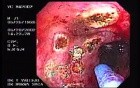 Radiation Proctosigmoiditis (12 of 14)