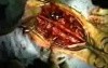 Spinal Fusion Surgery 