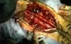 Spinal Fusion Surgery 