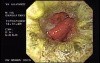 Zollinger- Ellison Syndrome - Gastric Ulcer with Gastrocolic Fistula (21 of 21)
