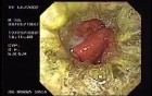 Zollinger- Ellison Syndrome - Gastric Ulcer with Gastrocolic Fistula (21 of 21)