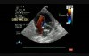 Combined Shunt: Ostium Secundum asd And Muscular vsd