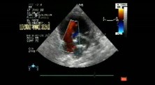 Combined Shunt: Ostium Secundum asd And Muscular vsd
