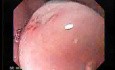 Large Gastric Varices (2 of 4)
