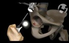 Future Total Hip Replacement Revision