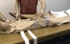 Emergency Splinting Femur Fracture