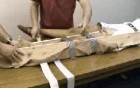 Emergency Splinting Femur Fracture