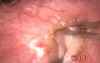 Inferior Oblique Myomectomy - 4 Steps