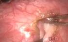 Inferior Oblique Myomectomy - 4 Steps