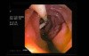 Stents In Bile Ducts In Gastroscopy