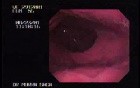 Reflux Esophagitis & Esophageal Stricture - Hiatal Hernia In Retroflexy