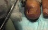Stage-3 ingrown Toenail: Electrocautery