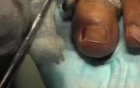 Stage-3 ingrown Toenail: Electrocautery