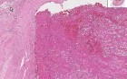 Thrombus, Atherosclerotic plaque - Histopathology of artery