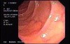 Crohn's Disease - Endoscopy (10 of 28)