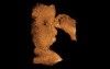 Cleft lip - 3D ultrasound picture