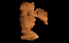 Cleft lip - 3D ultrasound picture