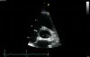 Parasternal View  At The Level Of The Aorta  Normal Study