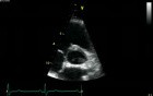 Parasternal View  At The Level Of The Aorta  Normal Study