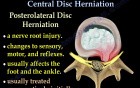 Central disc herniation - Video Lecture